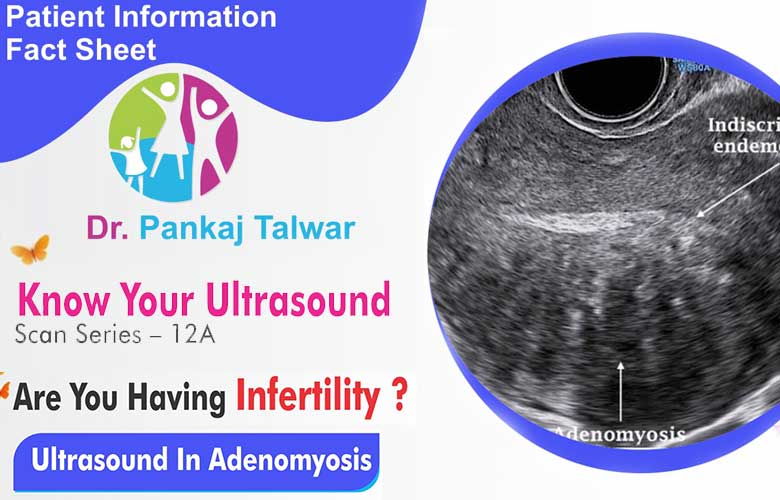 Ultrasound In Adenomyosis Fertility Treatment Center Delhi Ncr